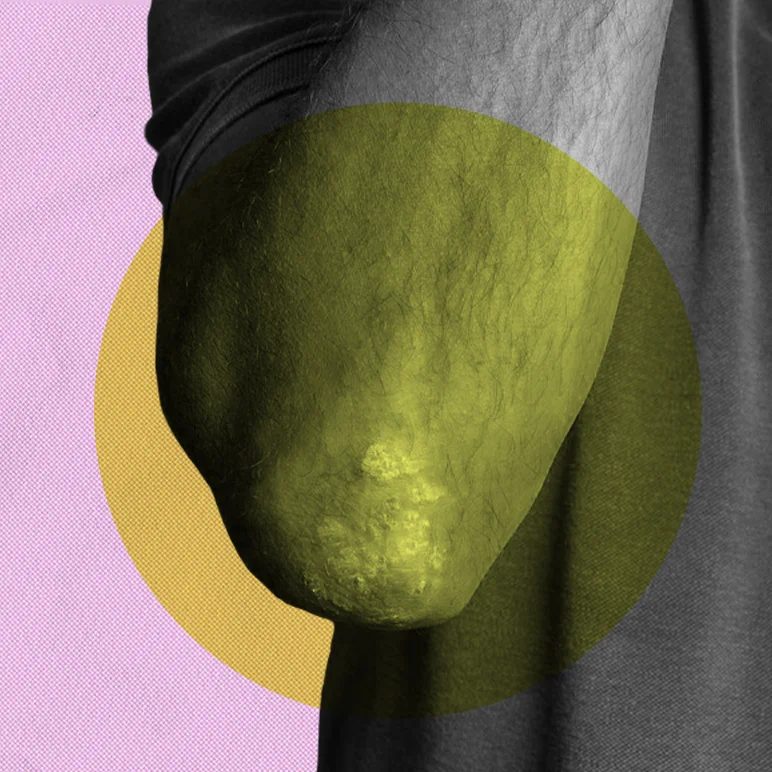 Лишай у человека