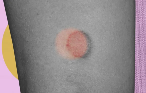 Розовый лишай