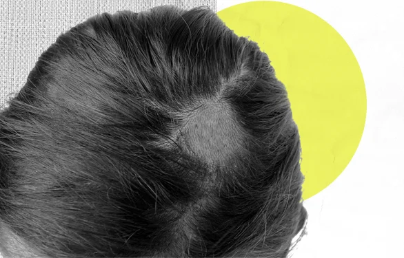 Стригущий лишай