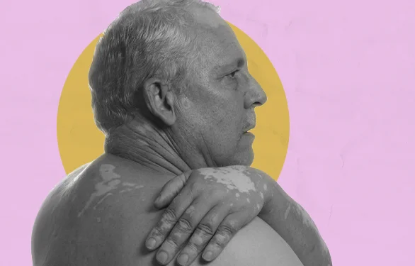 Отрубевидный лишай